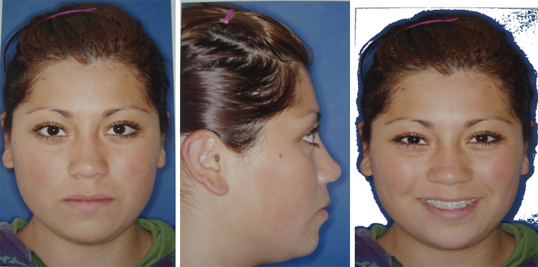 Fig. 10 Frente progreso / Fig. 11 Perfil de progreso / Fig. 12 Sonrisa progreso