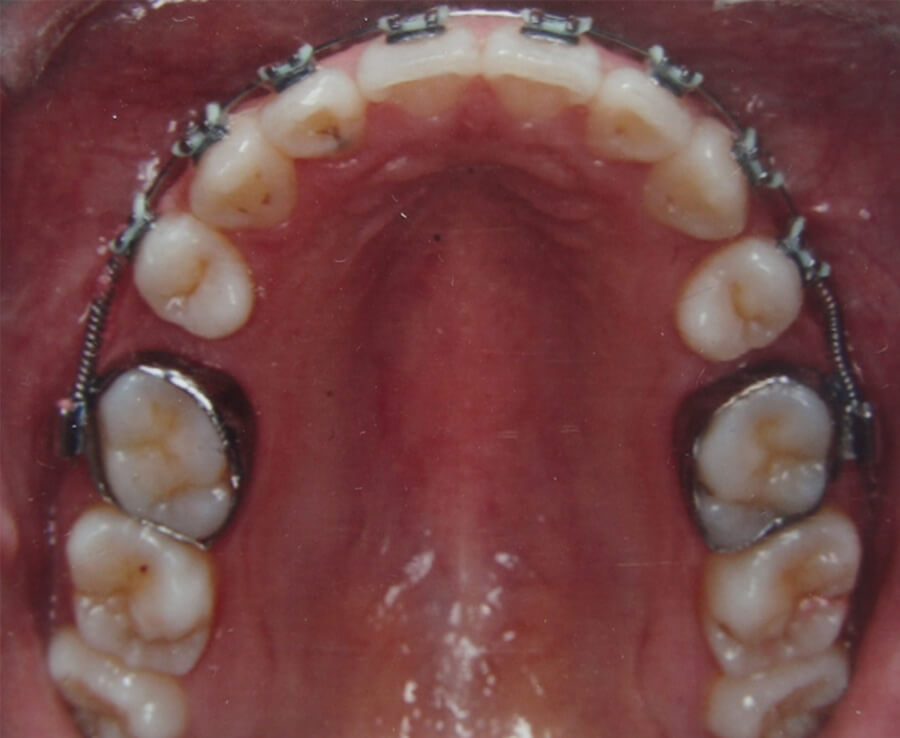 Fig. 13 Oclusal superior de progreso