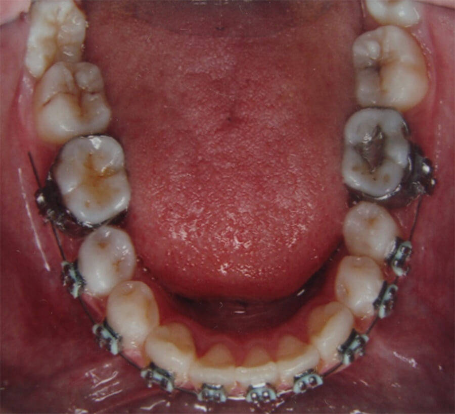 Fig. 14 Olcusal inferior de progreso