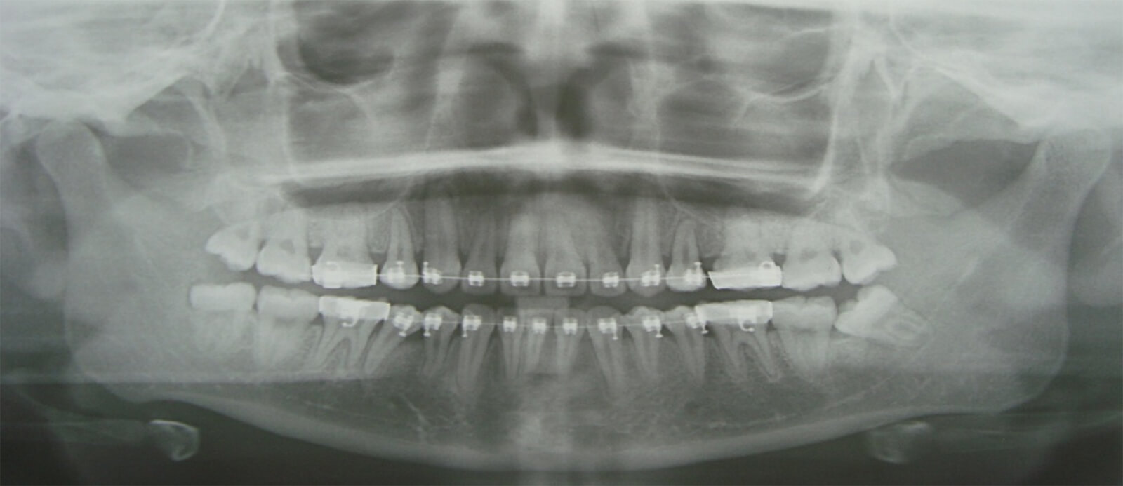 Fig. 17 Radiografías panorámica de progreso