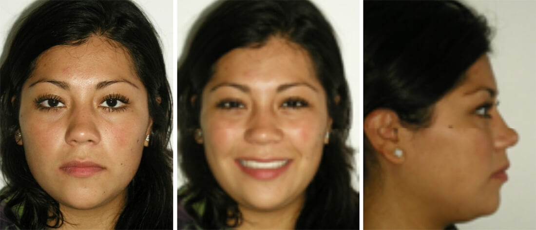 Fig 18 Final de frente / Fig.19 Fotografías de sonrisa / Fig 20 Fotografía de perfil
