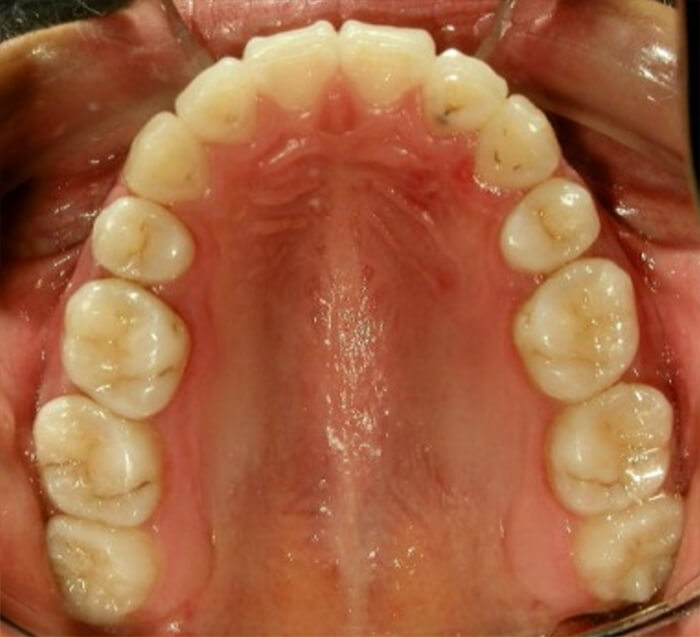 Fig 22 Fotografía oclusal superior