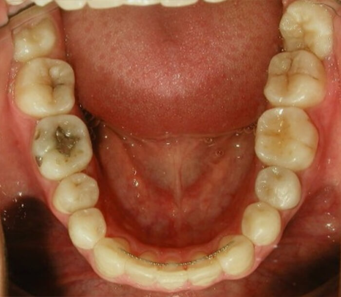 Fig 23 Oclusal inferior final
