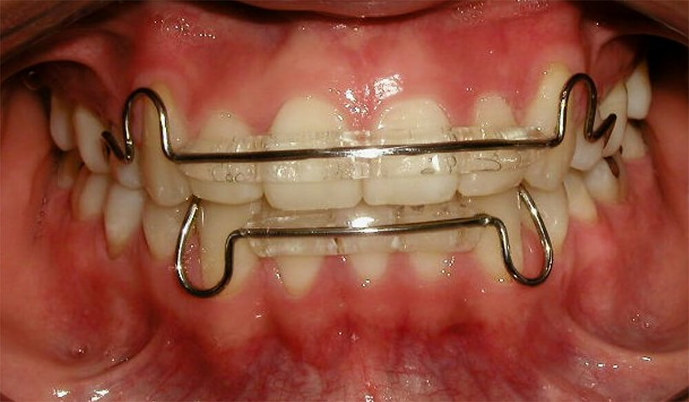 Fig 24 Fotografía de frente con retenedores Hawley con cinturón vestibular