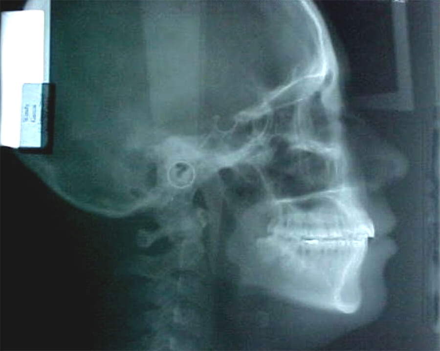 Fig 25 Radiografías lateral de cráneo