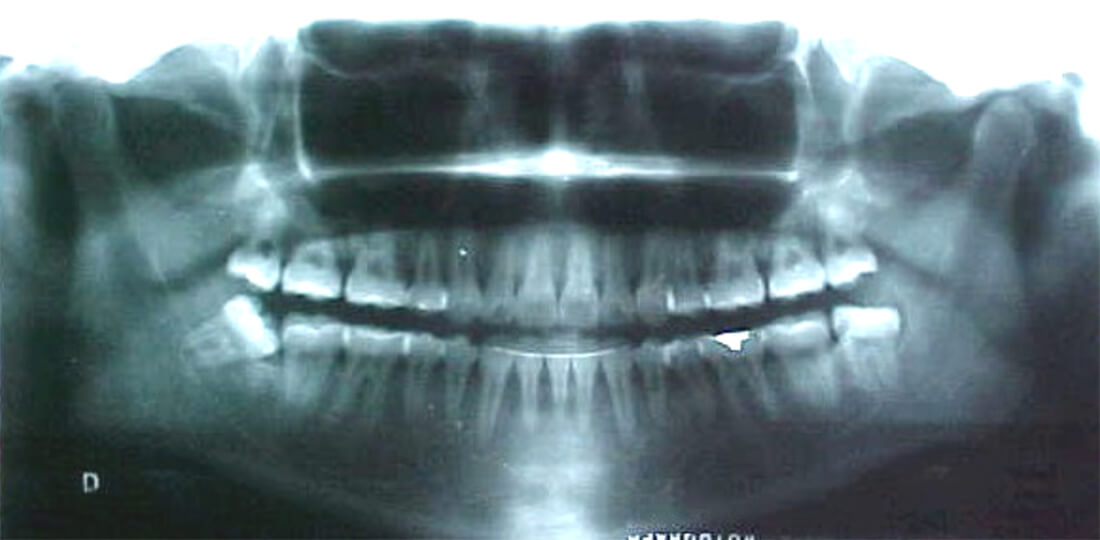 Fig. 26 Radiografía panorámica final