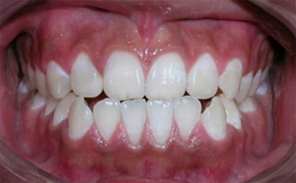Fig. 4 Fotografía intraoral de sonrisa en inicio