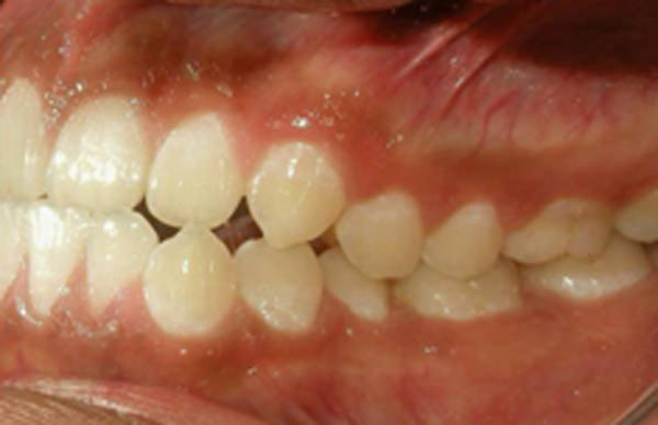 Fig. 6 Fotografía lateral derecha de inicio