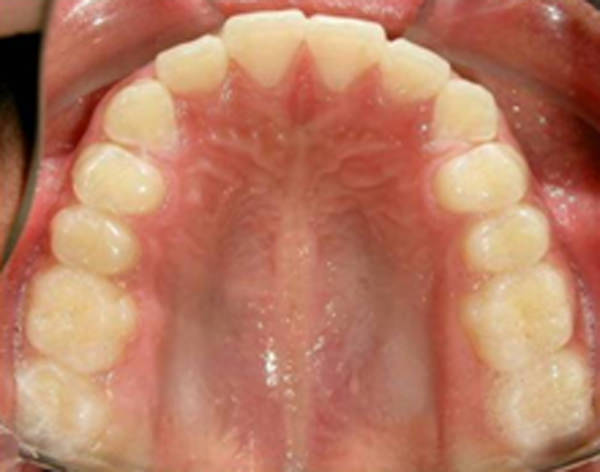 Fig. 7 Fotografia Oclusal superior de inicio