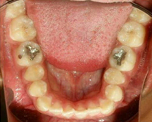 Fig 8 Fotografia Oclusal inferior de inicio