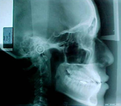 Fig .9 Rx lateral de cráneo de inicio