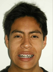 Fig.13 Sonrisa de progreso