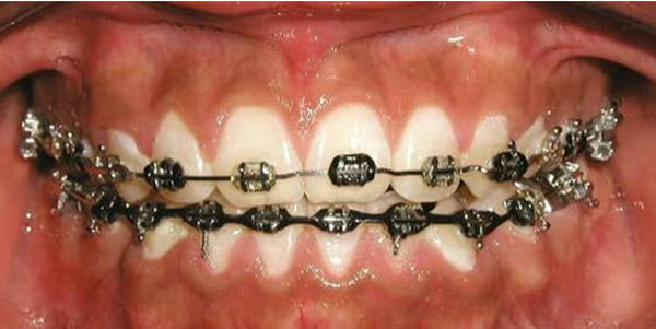 Fig.14 Fotografía de sonrisa de progreso