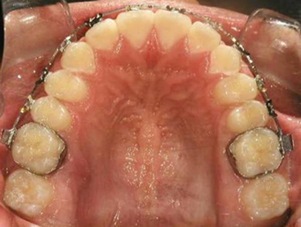 Fig.17 Fotografía oclusal superior de progreso