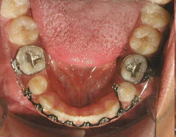 Fig 18 Fotografía oclusal inferior de progreso
