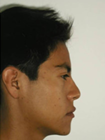 Fig. 22b Perfil final