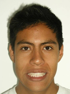 Fig.23 Fotografía de sonrisa de final
