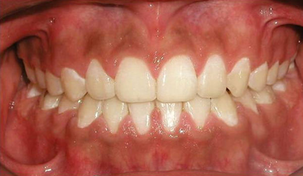 Fig.24 Fotografía intraoral de sonrisa de final