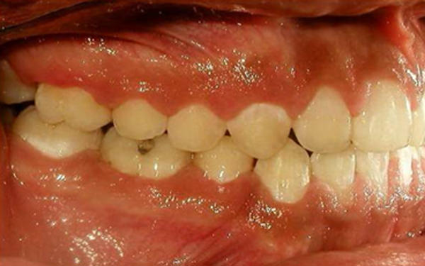 Fig. 25 Fotografía lateral derecha de final