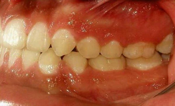 Fig. 26 Fotografía lateral izquierda de final
