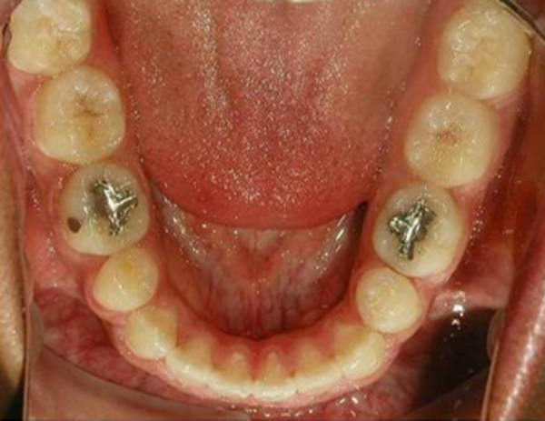 Figura 27 Fotografía oclusal inferior