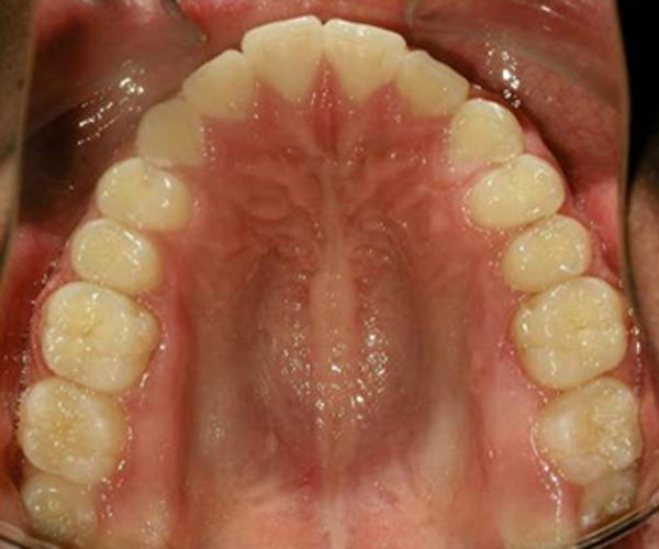 Fig. 28 Fotografía oclusal superior de final.