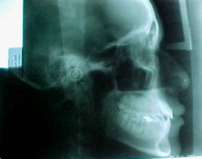 Fig. 29 Rx. Lateral de cráneo de final.