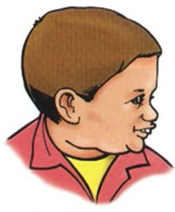 Fig.1 Paciente con Deglución Atípica.