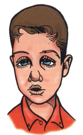 Fig.2 Paciente Respirador Bucal