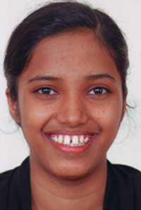 Fig 1 Pre treatment extra oral frontal smile