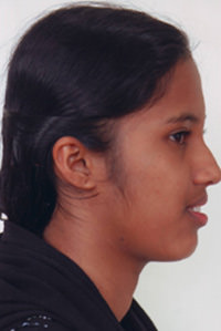 Fig.2 Pre treatment extra oral profile