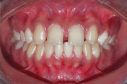 Fig.3 Pre-treatment Intra-oral frontal view
