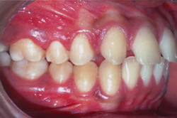 Fig.4 Pre-treatment Intra-oral right side view