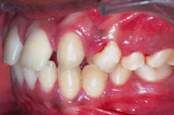 Fig.5 Pre-treatment Intra-oral left side view
