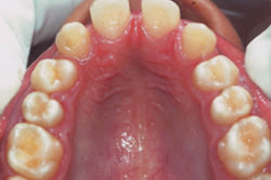 Fig.6 Pretreatment Maxillary arch occlusal view