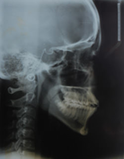 Fig.7 Pre treatment lateral cephalogram