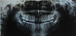 Fig.8 Pre treatment O.P.G