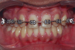 Fig.9 Appliance bonded to the maxillary arch.