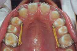 Fig.10 Derotation of Premolars