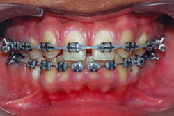 Fig 11 Appliance bonded to Mandibular arch