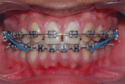 Fig.12 Mesialisation of maxillary canines