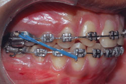 Fig.13 Intermaxillary Class III elastics placed bilaterally