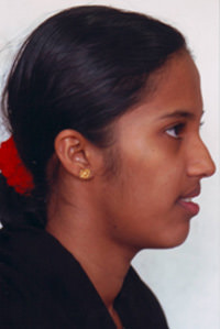 Fig.15 Post treatment extra oral profile