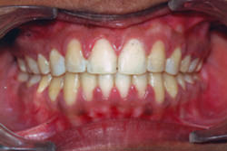 Fig.16 Post-treatment Intra-oral frontal