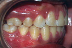 Fig.17 Post-treatment Intra-oral right side
