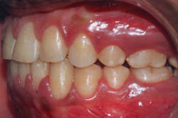Fig.18 Post-treatment Intra-oral left side