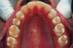 Fig.19 Prost treatment Maxillary arch occlusal