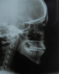Fig.20 Post treatment lateral cephalogram