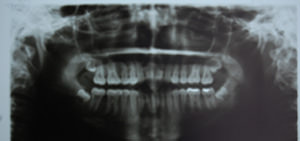 Fig.21 Post treatment O.P.G