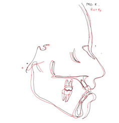 Fig.22 Pre-treatment and post-treatment lateral cephalogram superimposition. Black denotes pretreatment tracing. Red denotes post treatment